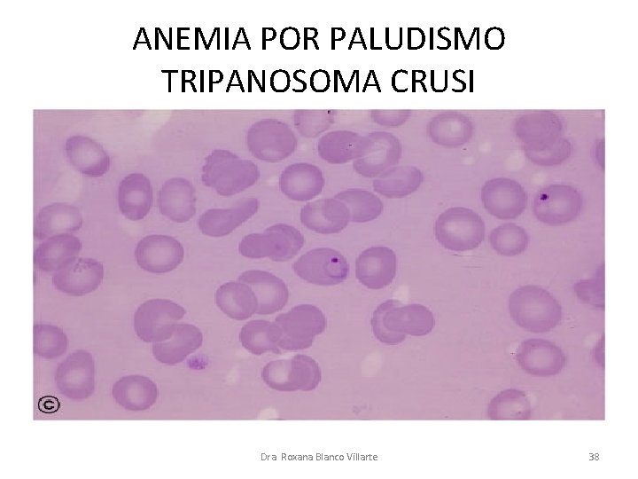 ANEMIA POR PALUDISMO TRIPANOSOMA CRUSI Dra. Roxana Blanco Villarte 38 