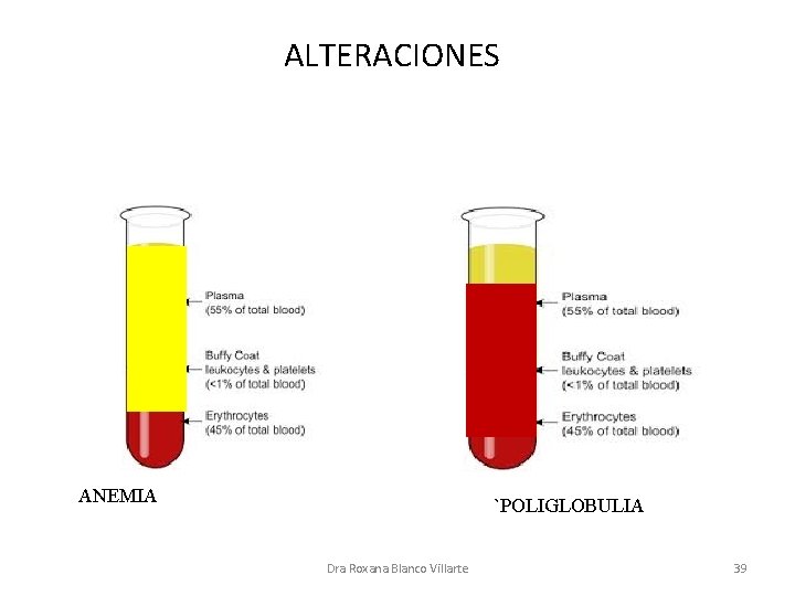 ALTERACIONES ANEMIA `POLIGLOBULIA Dra Roxana Blanco Villarte 39 