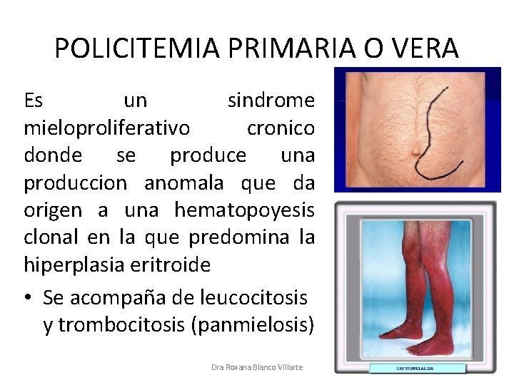 POLICITEMIA PRIMARIA O VERA Es un sindrome mieloproliferativo cronico donde se produce una produccion