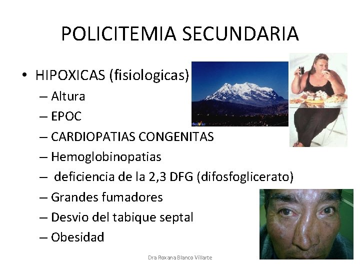 POLICITEMIA SECUNDARIA • HIPOXICAS (fisiologicas) – Altura – EPOC – CARDIOPATIAS CONGENITAS – Hemoglobinopatias