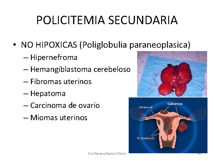 POLICITEMIA SECUNDARIA • NO HIPOXICAS (Poliglobulia paraneoplasica) – Hipernefroma – Hemangiblastoma cerebeloso – Fibromas
