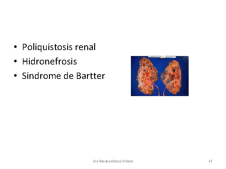  • Poliquistosis renal • Hidronefrosis • Sindrome de Bartter Dra Roxana Blanco Villarte