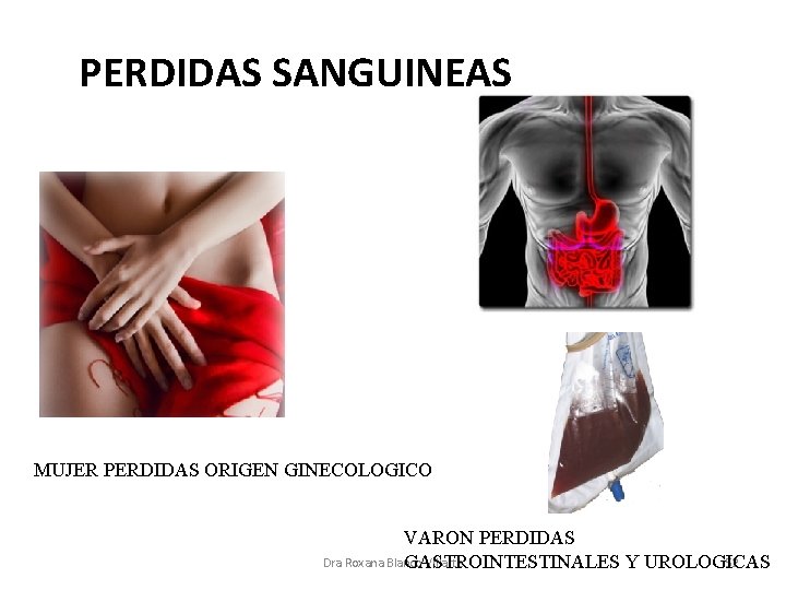 PERDIDAS SANGUINEAS MUJER PERDIDAS ORIGEN GINECOLOGICO VARON PERDIDAS Dra Roxana Blanco Villarte 52 GASTROINTESTINALES