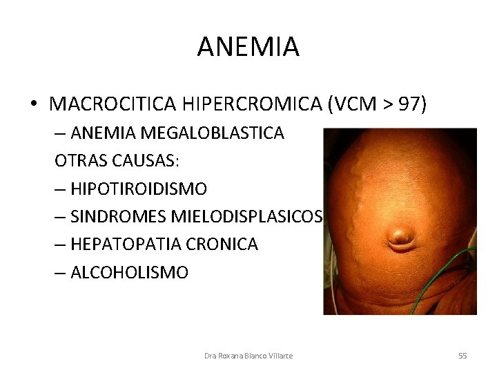 ANEMIA • MACROCITICA HIPERCROMICA (VCM > 97) – ANEMIA MEGALOBLASTICA OTRAS CAUSAS: – HIPOTIROIDISMO
