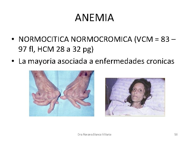 ANEMIA • NORMOCITICA NORMOCROMICA (VCM = 83 – 97 fl, HCM 28 a 32