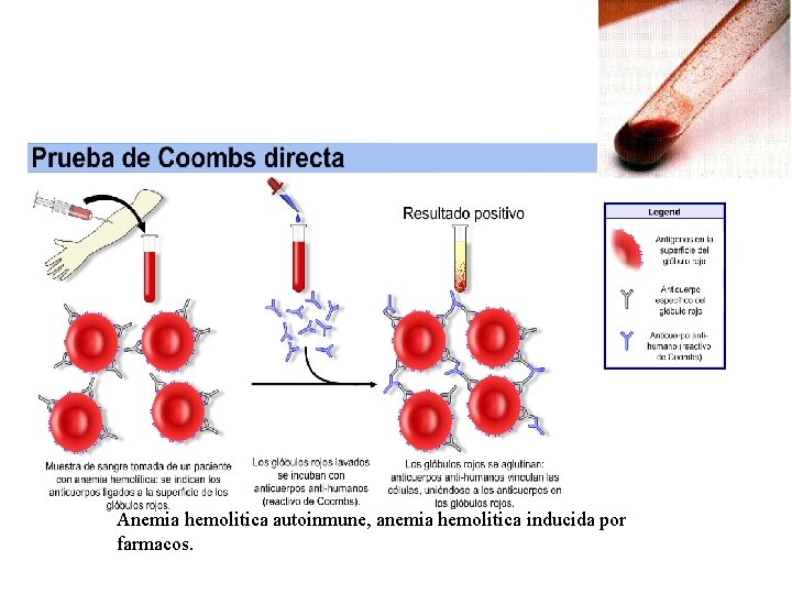 Anemia hemolitica autoinmune, anemia hemolitica inducida por farmacos. 