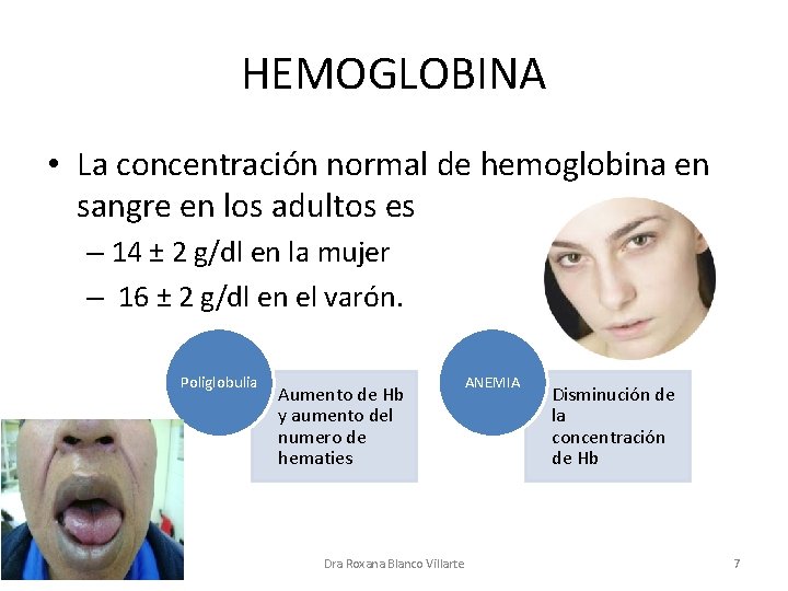 HEMOGLOBINA • La concentración normal de hemoglobina en sangre en los adultos es –
