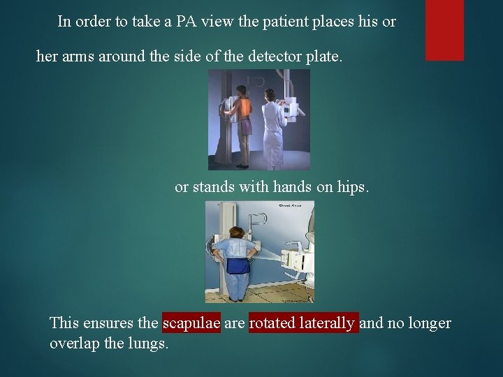 In order to take a PA view the patient places his or her arms