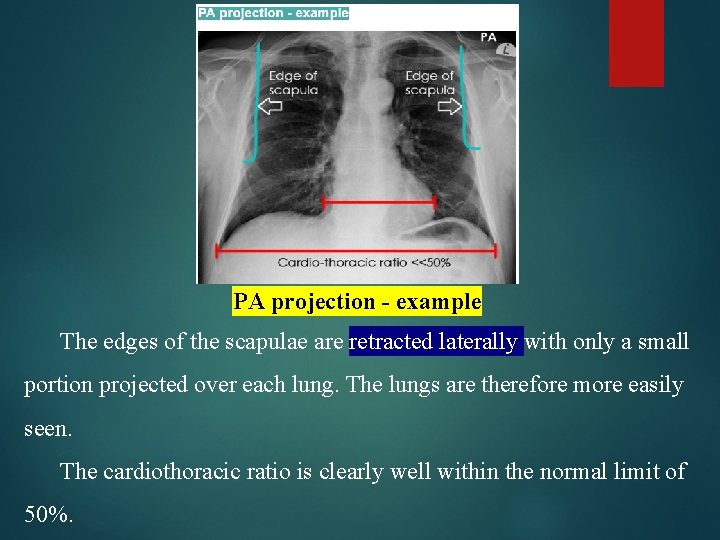 PA projection - example The edges of the scapulae are retracted laterally with only