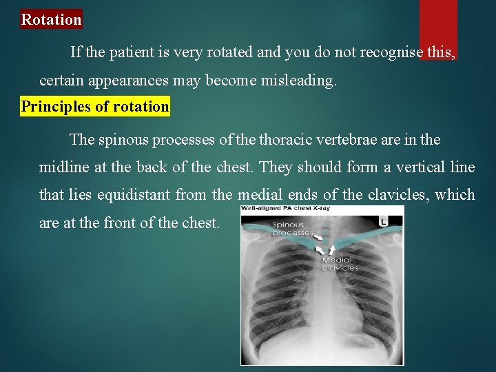 Rotation If the patient is very rotated and you do not recognise this, certain
