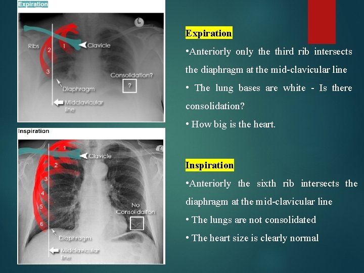 Expiration • Anteriorly only the third rib intersects the diaphragm at the mid-clavicular line