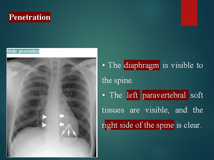 Penetration • The diaphragm is visible to the spine. • The left paravertebral soft