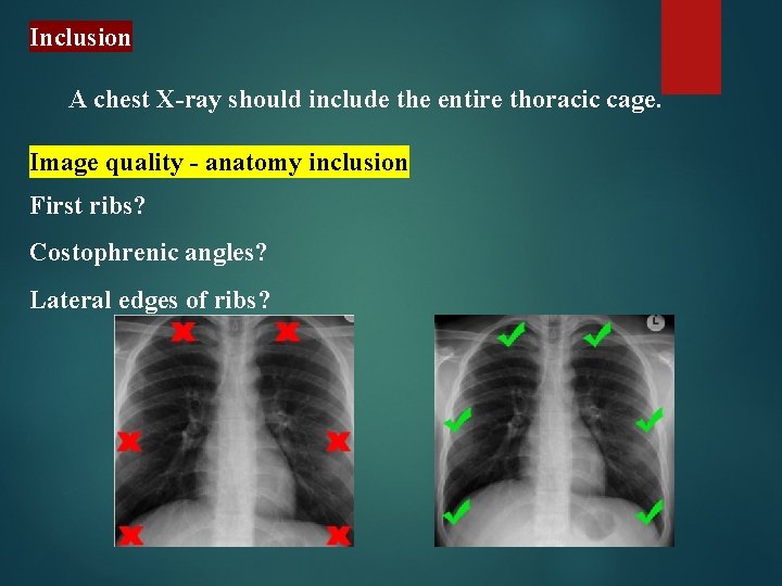 Inclusion A chest X-ray should include the entire thoracic cage. Image quality - anatomy
