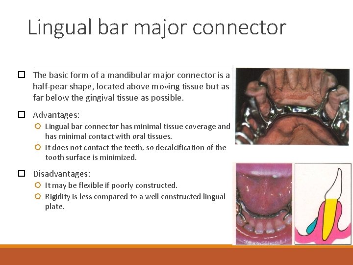 Lingual bar major connector The basic form of a mandibular major connector is a