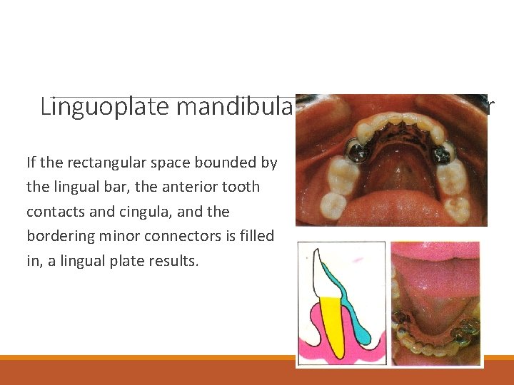 Linguoplate mandibular major connector If the rectangular space bounded by the lingual bar, the