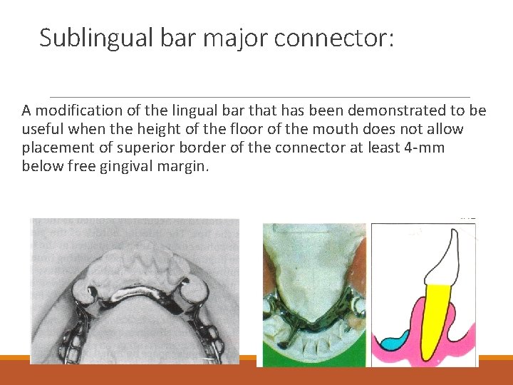 Sublingual bar major connector: A modification of the lingual bar that has been demonstrated