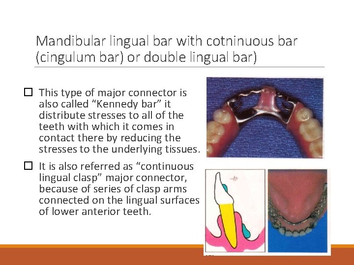 Mandibular lingual bar with cotninuous bar (cingulum bar) or double lingual bar) This type