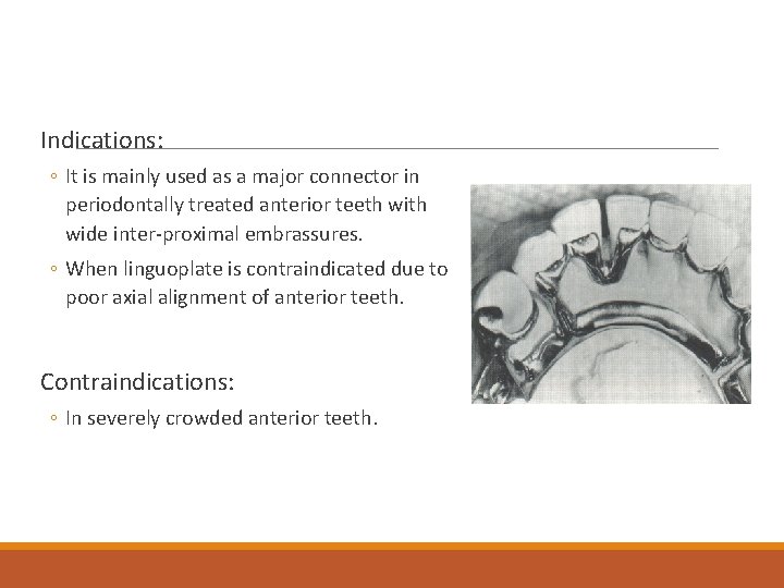 Indications: ◦ It is mainly used as a major connector in periodontally treated anterior