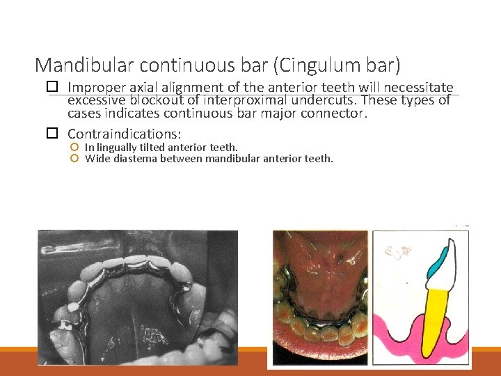 Mandibular continuous bar (Cingulum bar) Improper axial alignment of the anterior teeth will necessitate
