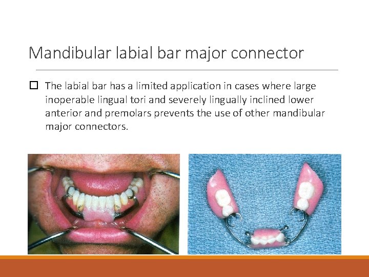 Mandibular labial bar major connector The labial bar has a limited application in cases