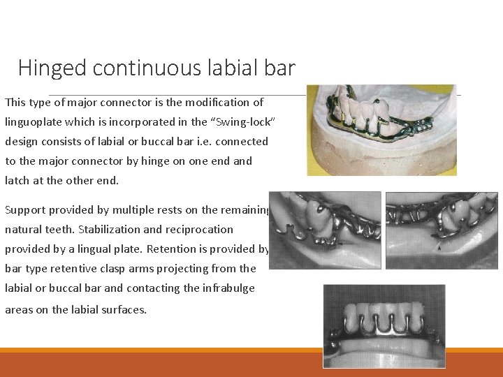 Hinged continuous labial bar This type of major connector is the modification of linguoplate