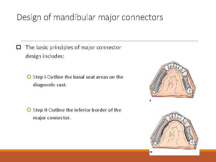Design of mandibular major connectors The basic principles of major connector design includes: Step