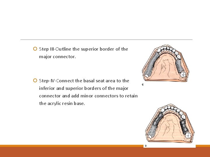  Step III-Outline the superior border of the major connector. Step-IV-Connect the basal seat