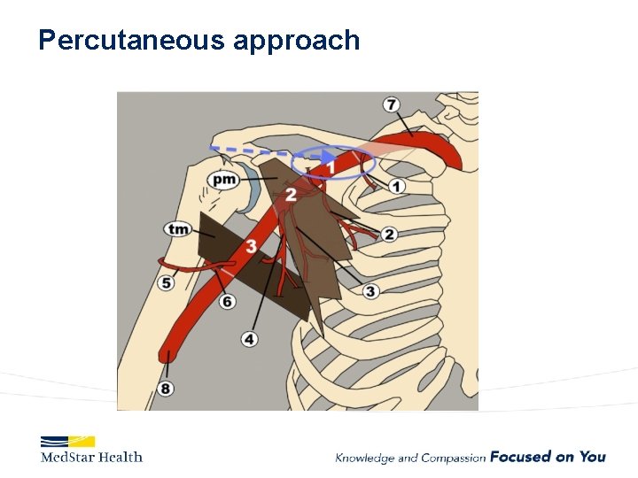 Percutaneous approach 