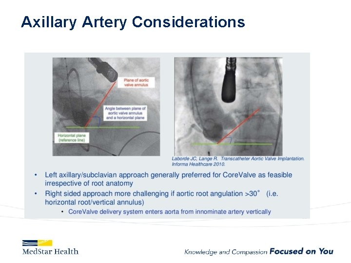 Axillary Artery Considerations 
