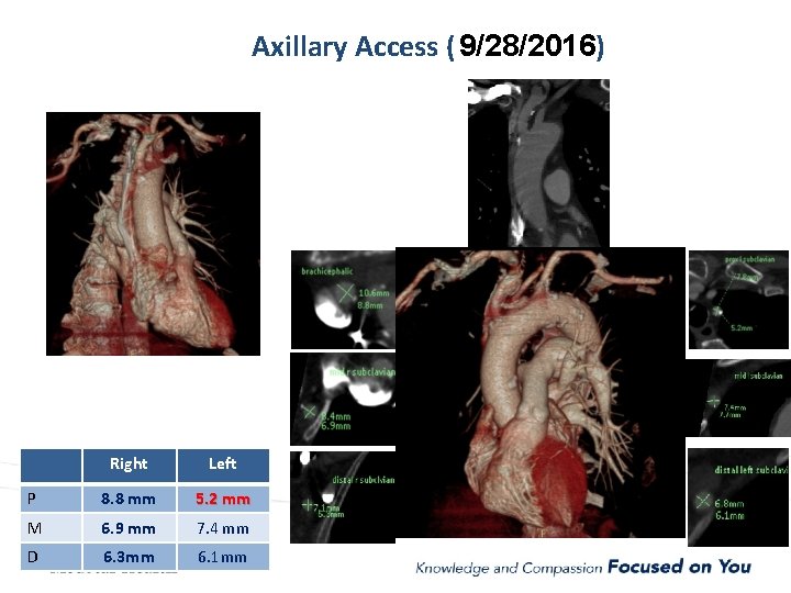 Axillary Access ( 9/28/2016) Right Left P 8. 8 mm 5. 2 mm M