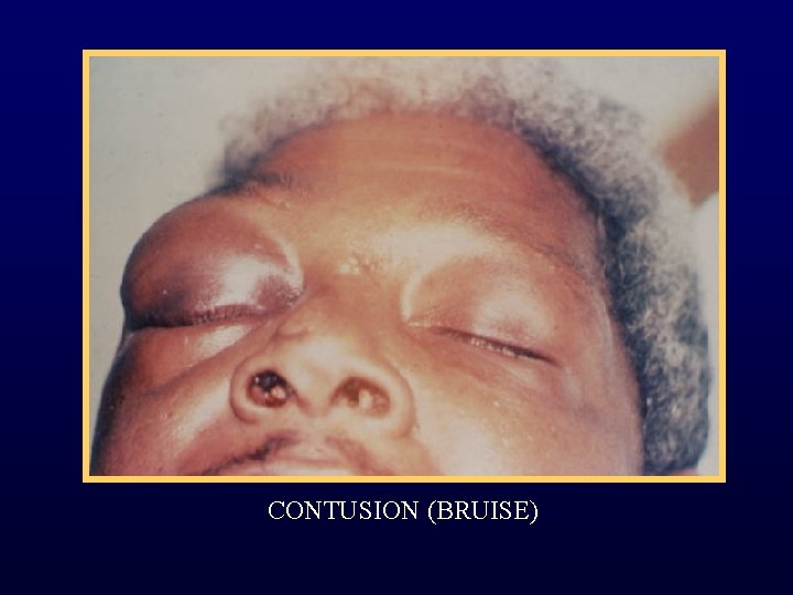 CONTUSION (BRUISE) 