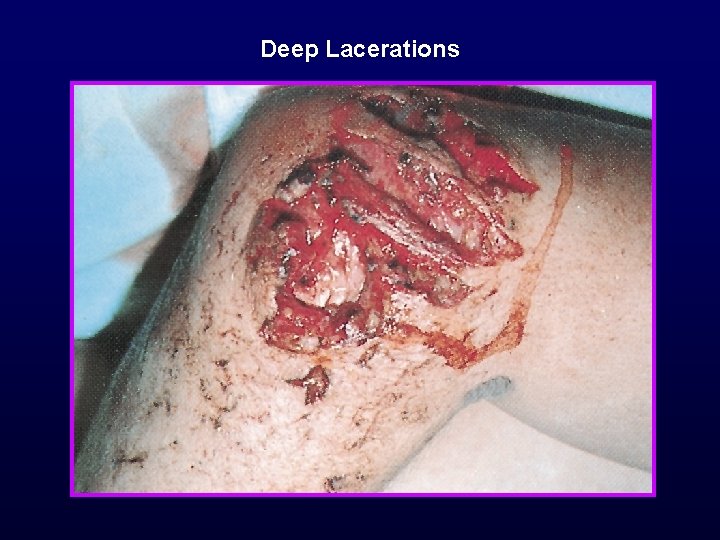 Deep Lacerations 