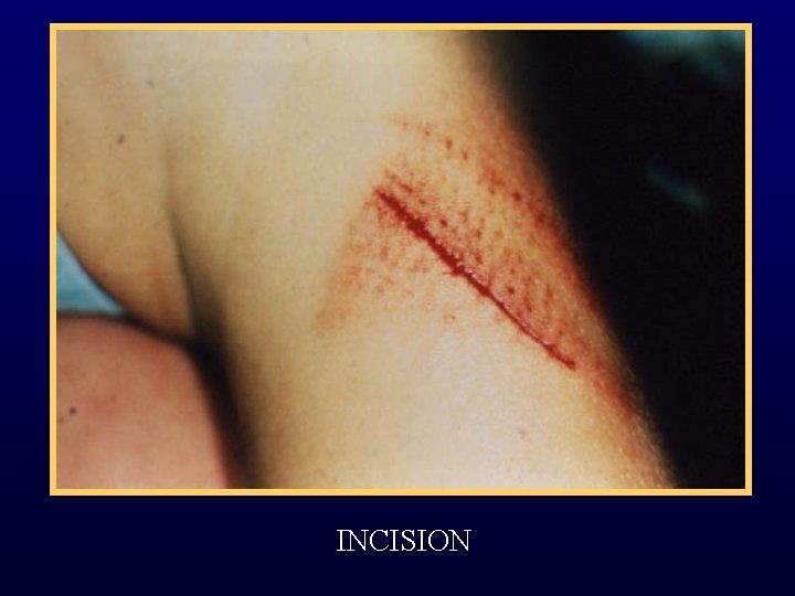 INCISION 
