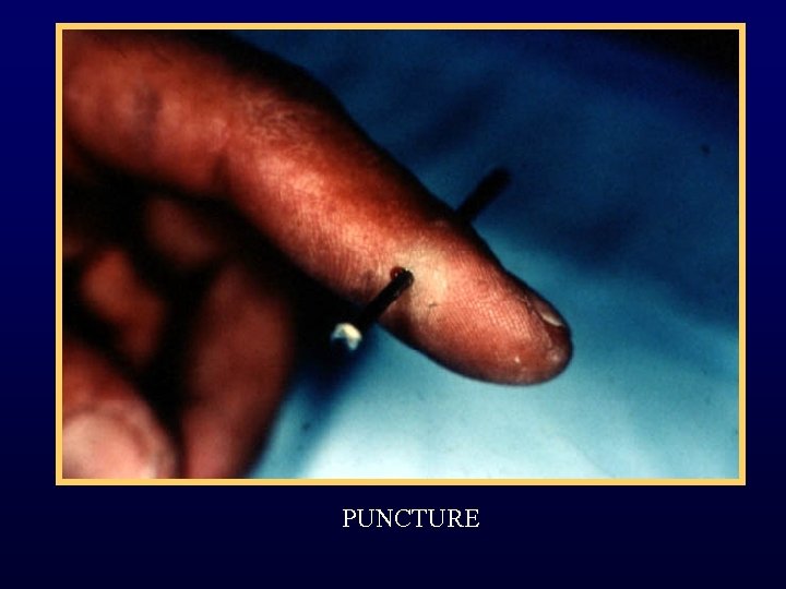 PUNCTURE 