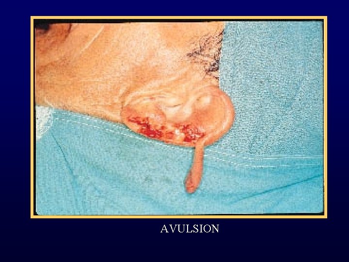AVULSION 