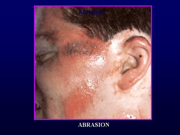 Abrasion ABRASION 