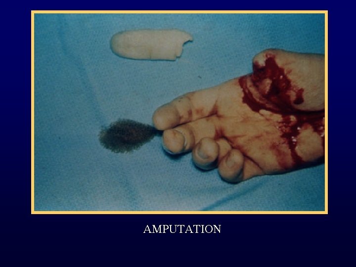 AMPUTATION 