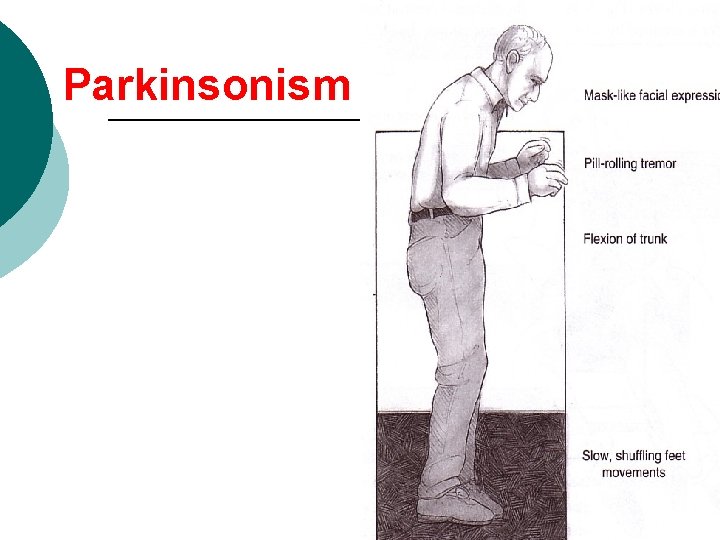 Parkinsonism 