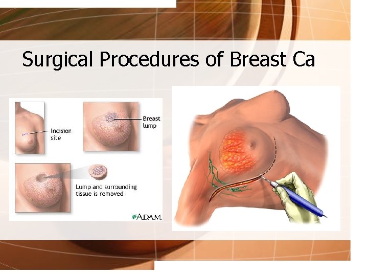 Surgical Procedures of Breast Ca 