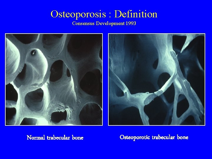 Osteoporosis : Definition Consensus Development 1993 Normal trabecular bone Osteoporotic trabecular bone 