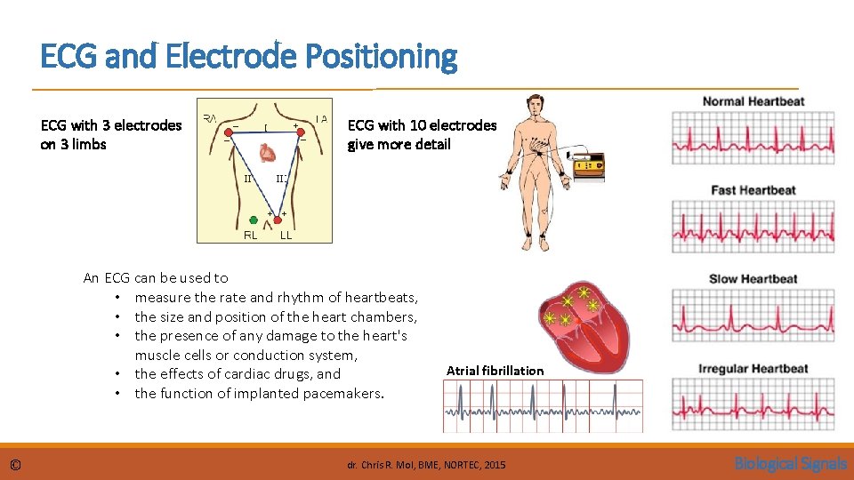 ECG and Electrode Positioning ECG with 3 electrodes on 3 limbs ECG with 10