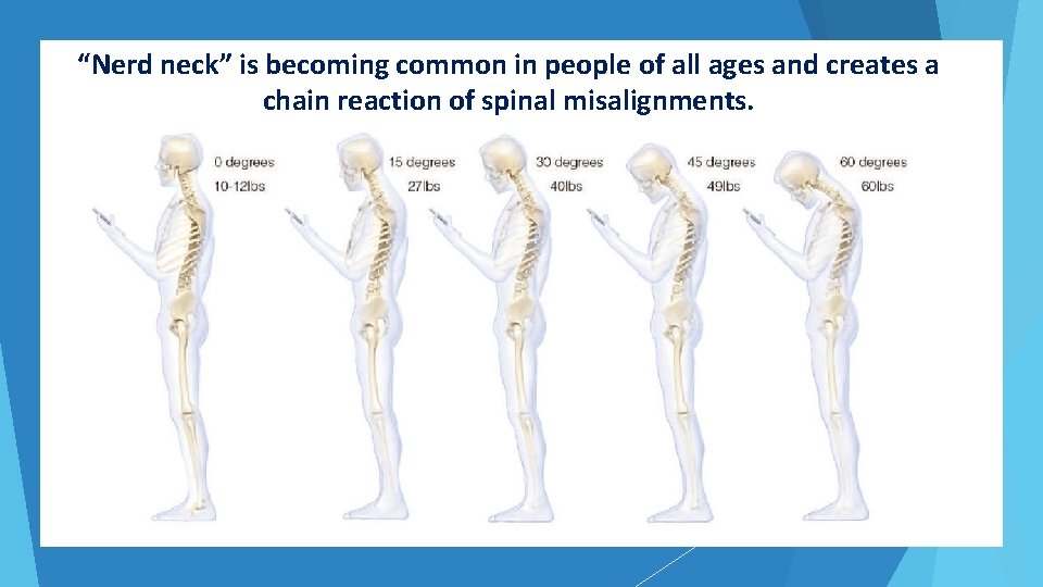 “Nerd neck” is becoming common in people of all ages and creates a chain