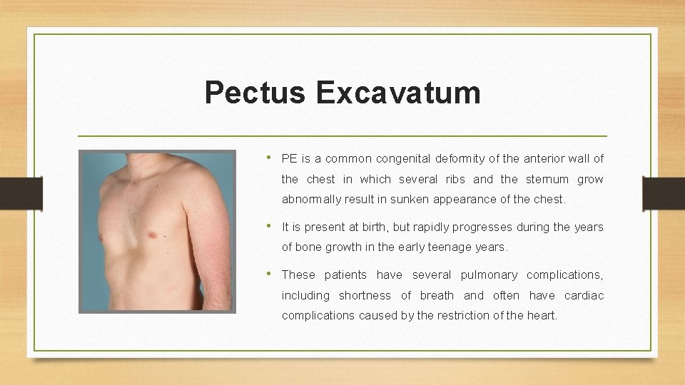 Pectus Excavatum • PE is a common congenital deformity of the anterior wall of