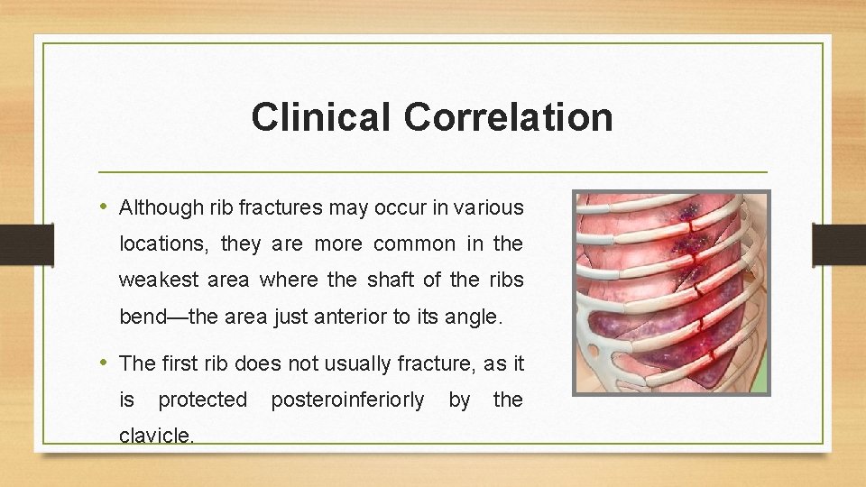 Clinical Correlation • Although rib fractures may occur in various locations, they are more