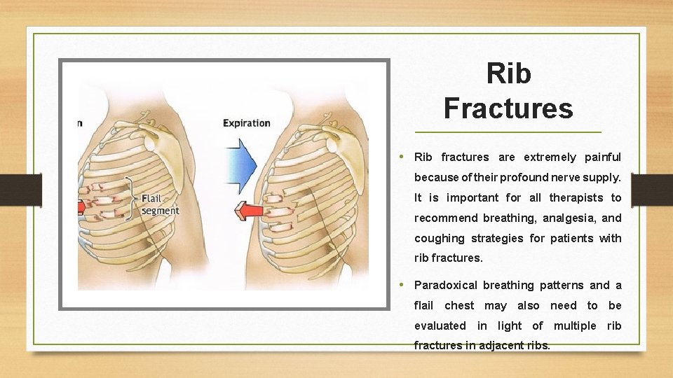 Rib Fractures • Rib fractures are extremely painful because of their profound nerve supply.