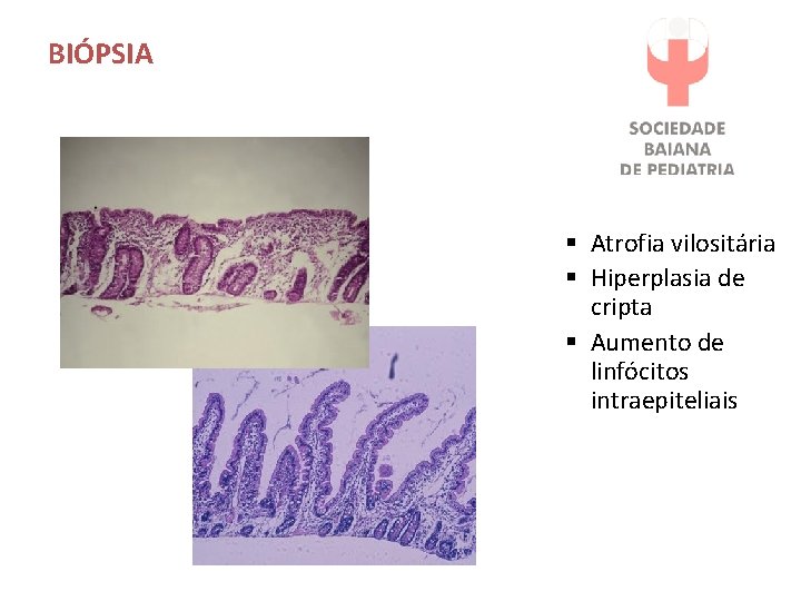 BIÓPSIA § Atrofia vilositária § Hiperplasia de cripta § Aumento de linfócitos intraepiteliais 