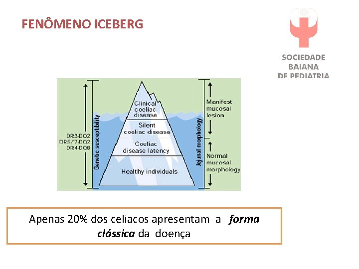 FENÔMENO ICEBERG Apenas 20% dos celíacos apresentam a forma clássica da doença 