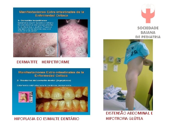 DERMATITE HERPETIFORME HIPOPLASIA DO ESMALTE DENTÁRIO DISTENSÃO ABDOMINAL E HIPOTROFIA GLÚTEA 