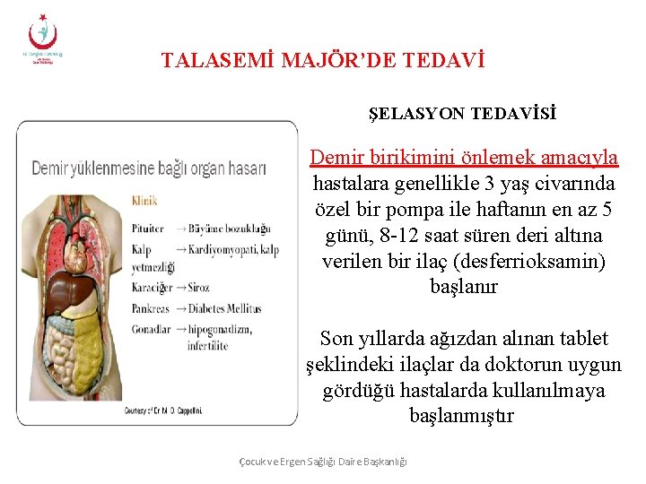 TALASEMİ MAJÖR’DE TEDAVİ ŞELASYON TEDAVİSİ Demir birikimini önlemek amacıyla hastalara genellikle 3 yaş civarında