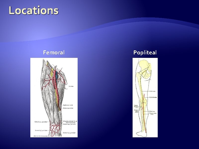 Locations Femoral Popliteal  Locations Femoral Popliteal